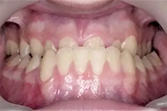 http://brisbane-orthodontics.com.au/under-bite