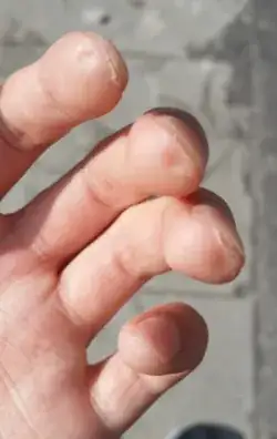 Ugly fingers