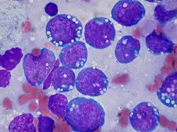 Burkitt-Lymphom, Histologie.