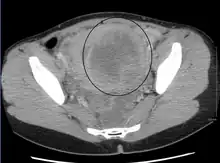 A very large (9&nbsp;cm) fibroid of the uterus which is causing pelvic congestion syndrome as seen on CT