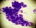 A cluster of basaloid cells on a smear taken from a patient with basal cell carcinoma (May-Grünwald Giemsa x1000).