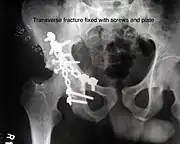 Transverse fracture fixed with screws and plate
