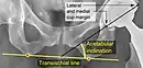 Acetabular inclination. This parameter is calculated on an anteroposterior radiograph as the angle between a line through the lateral and medial margins of the acetabular cup and the transischial line which is tangential to the inferior margins of the ischium bones.
