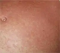 Typical fine-spotted pink rash of acute African trypanosomiasis on the skin of the abdomen ("trypanid rash")