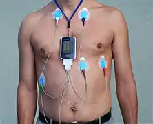 A 5-lead placement EASI configuration Holter monitor