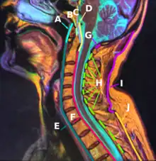 F: Posterior  longitudinal ligament
