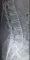 Lumbar spine showing advanced ankylosing spondylitis which can lead to spinal stenosis