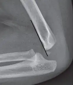 The anterior humeral line is not reliable in children with sparse ossification of the capitulum, such as in this 6 months old child.