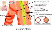 A diagram of an asthmatic's airways.