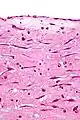 Atrial myxoma covered by endothelium. H&E stain.