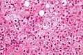 Ballooning degeneration. H&E stain.