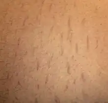 Fuzzy red lines on an abdomen