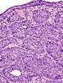 Histopathology representing an inverted papilloma of the urinary bladder that was cystoscopically resected. Hematoxylin and eosion stain.