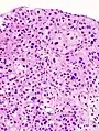 Histopathology of urothelial carcinoma of the urinary bladder, showing a nested pattern of invasion. Transurethral biopsy. H&E stain