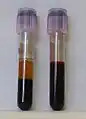 Two tubes of EDTA-anticoagulated blood. Left tube: after standing, the RBCs have settled at the bottom of the tube. Right tube: Freshly drawn blood