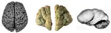 Normal human adult cerebrum (gyrencephaly)(left), polymicrogyria (center) and lissencephaly (right).