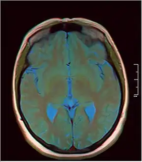 MRI axial in false color