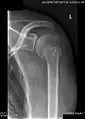 Radiograph showing a bony Bankart lesion with stationary fragment at the inferior glenoid