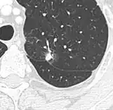 Nodule with pleural retraction.