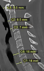 CT scan with upper limits of the thickness of the prevertebral space at different levels