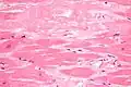 Cardiac amyloidosis. H&E stain.