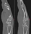 Carpal boss in CT.