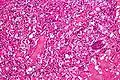 Micrograph of cerebellar hemangioblastoma. HPS stain.