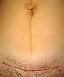 A caesarean section scar (horizontal red line) and linea nigra visible on a 31-year-old woman seven weeks after childbirth.