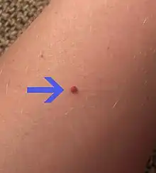 A cherry angioma on a person's arm
