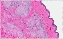 Cutaneous Myxoma