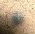 Dermatofibroma