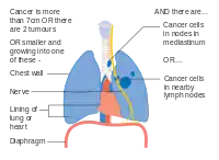 Stage IIIA lung cancer, if there is one feature from the list on each side