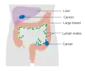 Dukes stage D bowel cancer; the cancer has metastasized.