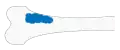 Stage 1A bone cancer