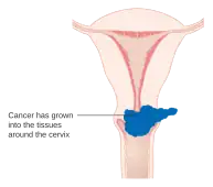 Stage 2B cervical cancer