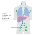 Stage 3 Hodgkin lymphoma