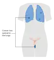 Stage 4B vaginal cancer