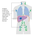Stage 4 Hodgkin lymphoma