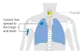 Stage M1 thyroid cancer