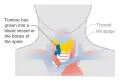 Stage T4b thyroid cancer