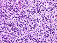Histopathology of diffuse large B-cell lymphoma occurring in the tonsil. H&E stain.