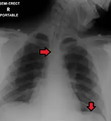 Portable chest (ie, antero-posterior view) showing endotracheal tube and Levin tube, both properly in place.