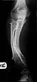 Multiple osteochondromas causing deformity of the forearm (shortening of the Radius with secondary bowing of the Ulna).