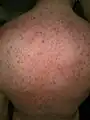 TENS Blisters on day 4