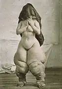 A striking example of objectification. Published as Bellevue Venus by Oscar G. Mason, for depicting elephantiasis.
