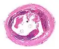 Cross section of the appendix with Enterobius with H&E stain