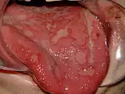 Erythema multiforme of tongue