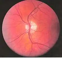 Eye vessels