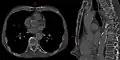 Sternal foramen on axial and sagittal CT. The "bow tie" appearance is seen on the axial view.