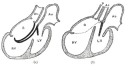 Diagrams to illustrate the transformation of the bulbus cordis. Ao. Truncus arteriosus. Au. Atrium. B. Bulbus cordis. RV. Right ventricle. LV. Left ventricle. P. Pulmonary artery.